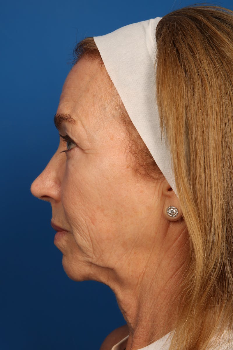 Laser Skin Resurfacing Before & After Gallery - Patient 148953 - Image 10