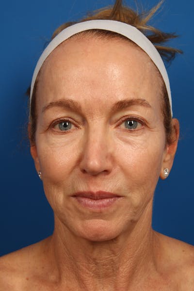 Laser Skin Resurfacing Before & After Gallery - Patient 148953 - Image 1