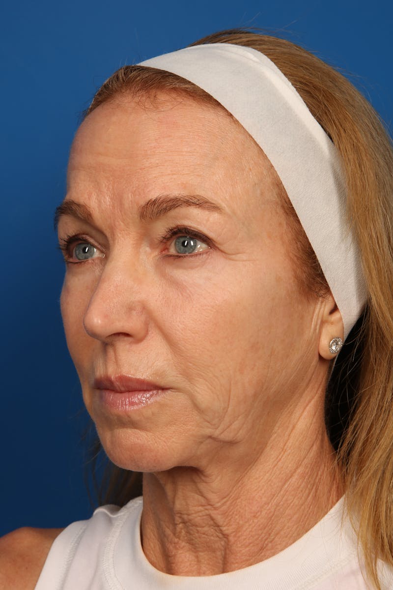 Laser Skin Resurfacing Before & After Gallery - Patient 148953 - Image 8