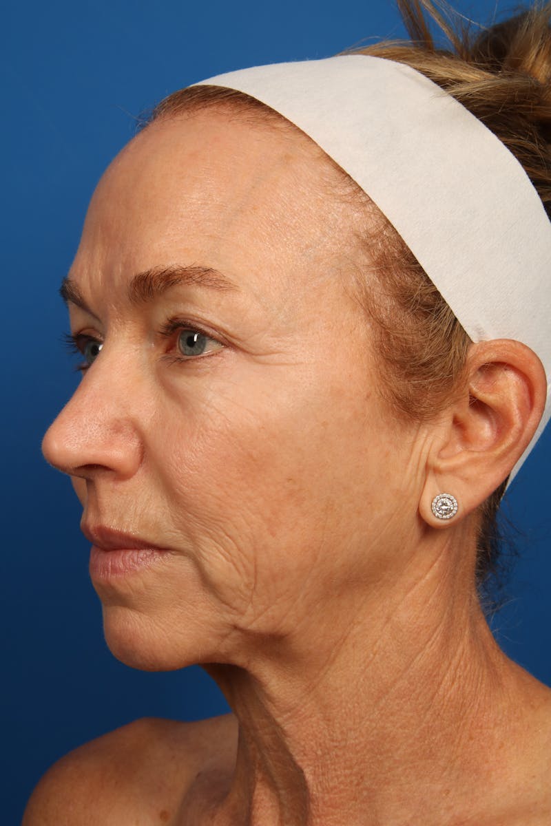 Laser Skin Resurfacing Before & After Gallery - Patient 148953 - Image 7