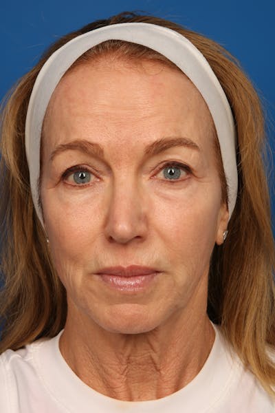 Laser Skin Resurfacing Before & After Gallery - Patient 148953 - Image 2