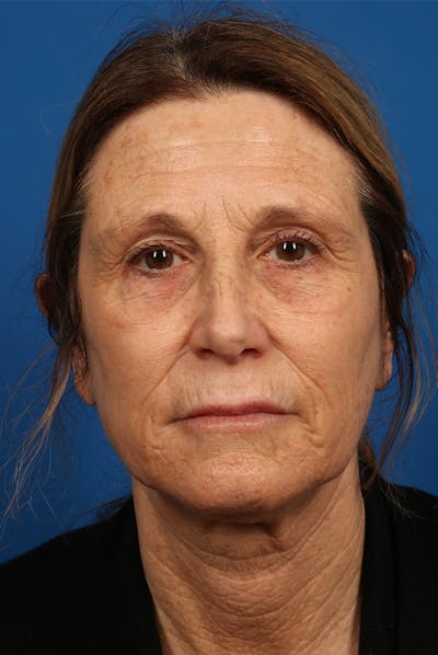 Laser Skin Resurfacing Before & After Gallery - Patient 423834 - Image 1