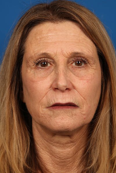 Laser Skin Resurfacing Before & After Gallery - Patient 423834 - Image 2