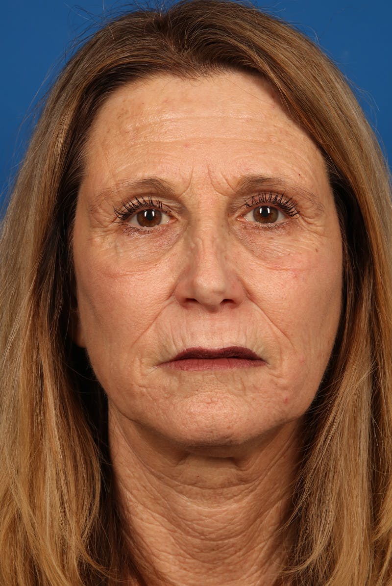 Laser Skin Resurfacing Before & After Gallery - Patient 423834 - Image 2