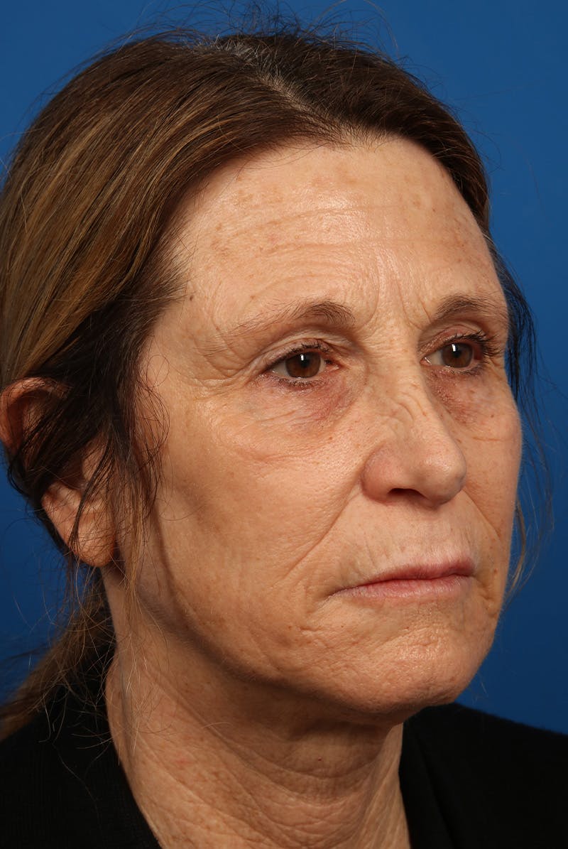 Laser Skin Resurfacing Before & After Gallery - Patient 423834 - Image 3