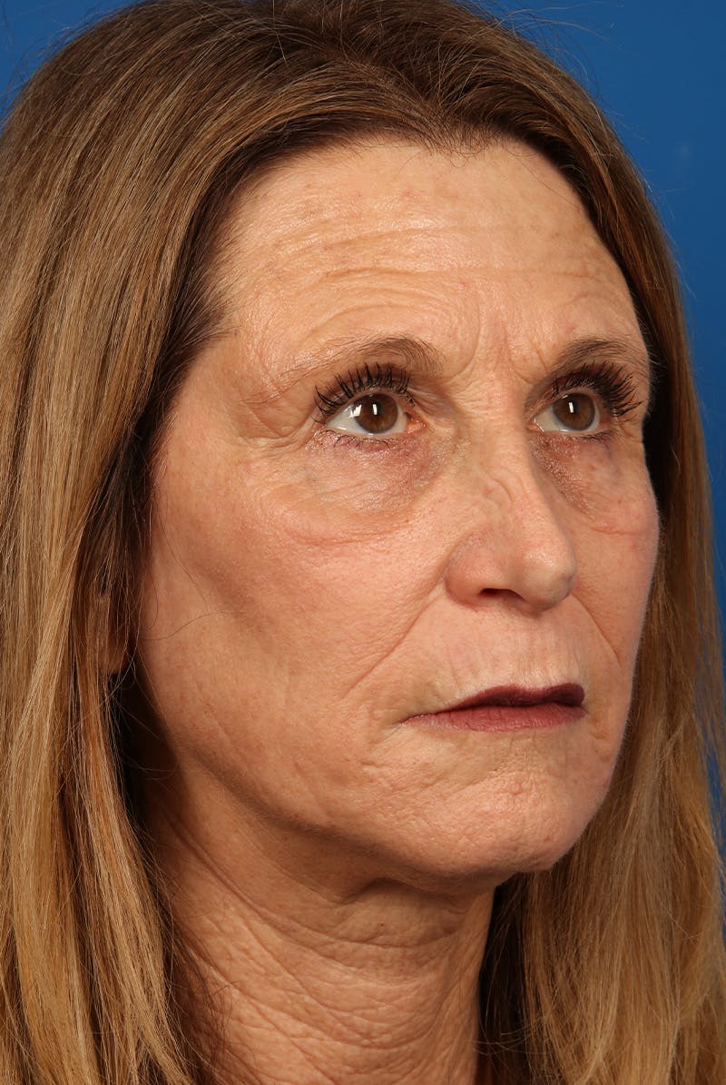 Laser Skin Resurfacing Before & After Gallery - Patient 423834 - Image 4