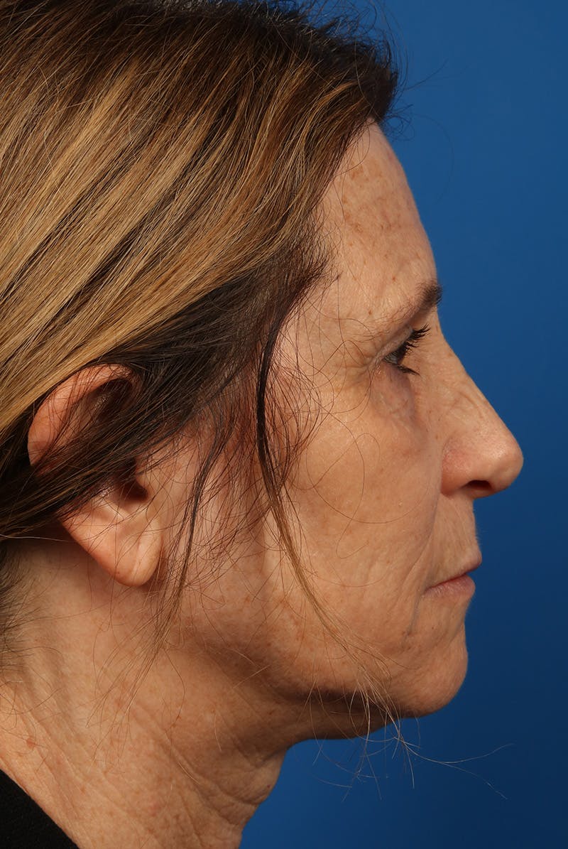 Laser Skin Resurfacing Before & After Gallery - Patient 423834 - Image 5