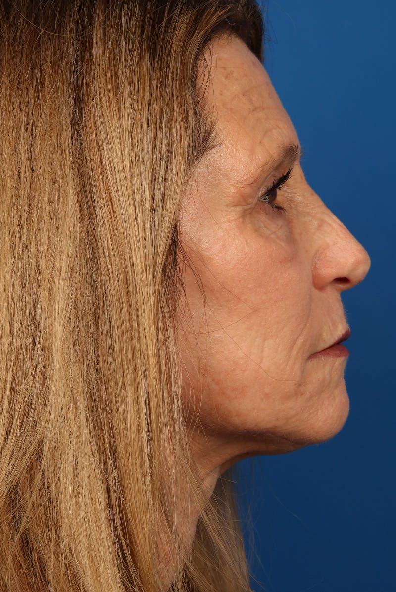 Laser Skin Resurfacing Before & After Gallery - Patient 423834 - Image 6