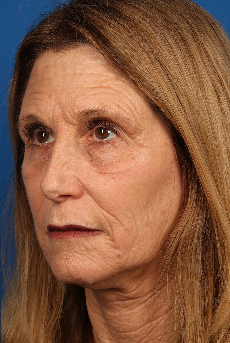 Laser Skin Resurfacing Before & After Gallery - Patient 423834 - Image 8