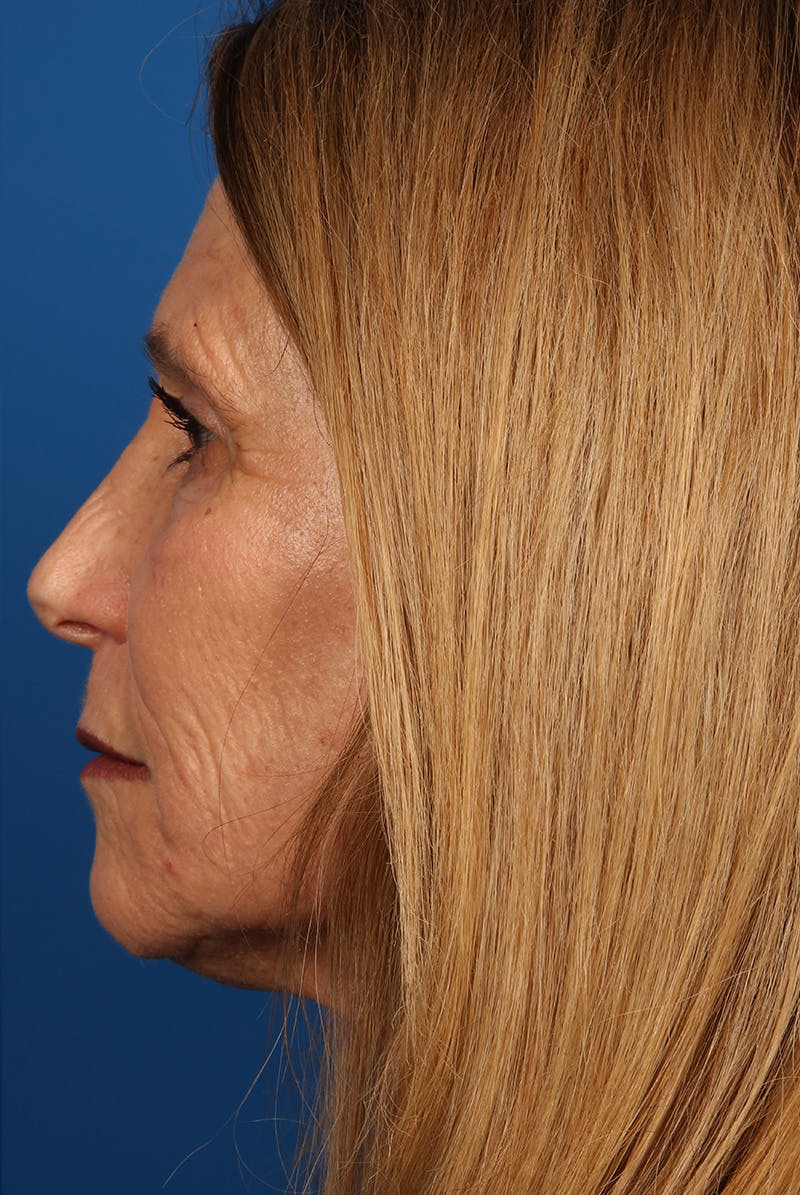 Laser Skin Resurfacing Before & After Gallery - Patient 423834 - Image 10
