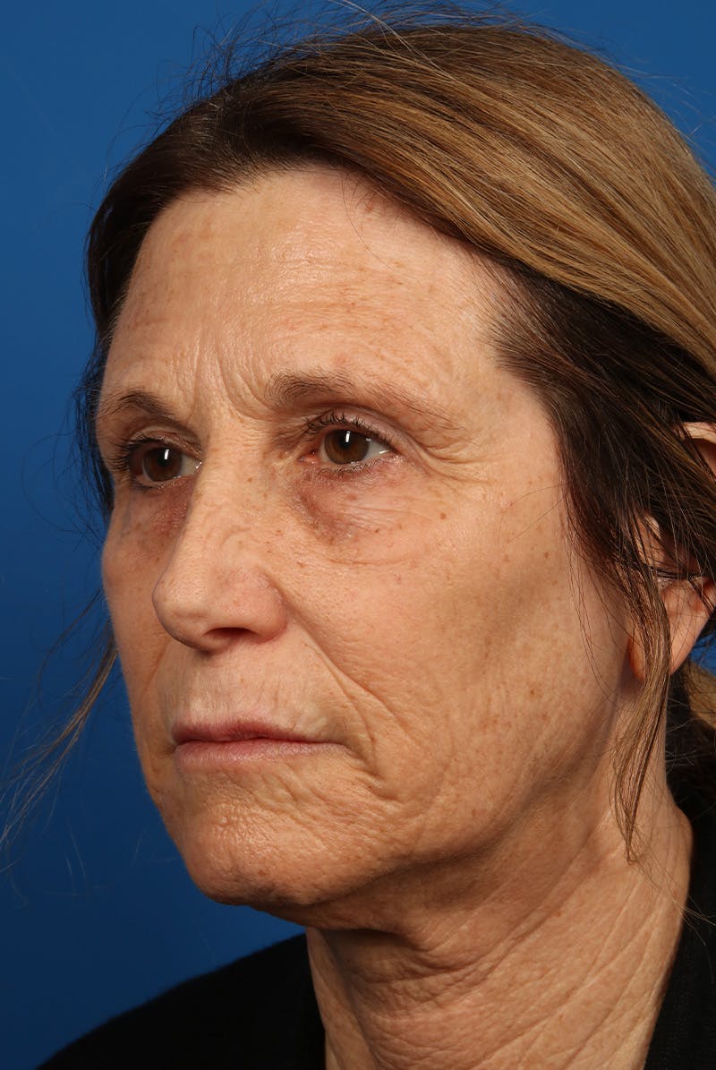 Laser Skin Resurfacing Before & After Gallery - Patient 423834 - Image 7