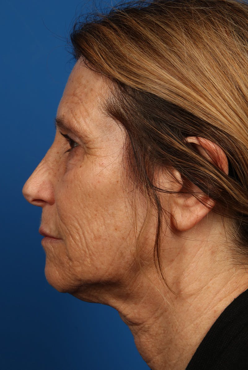 Laser Skin Resurfacing Before & After Gallery - Patient 423834 - Image 9