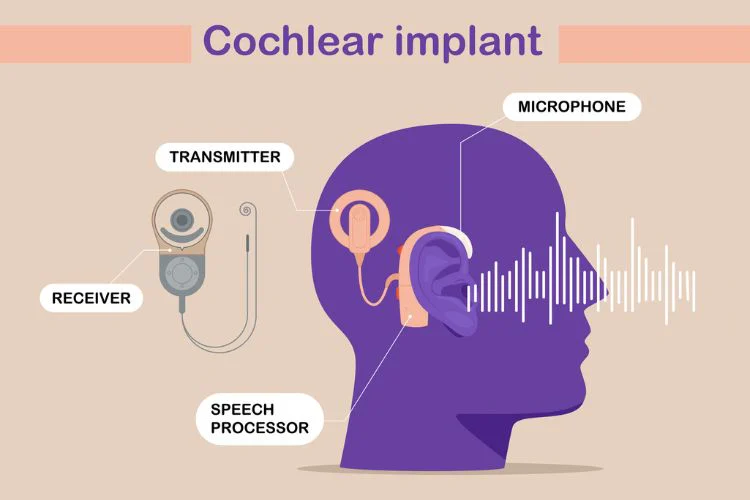 Diagram of cochlear implant