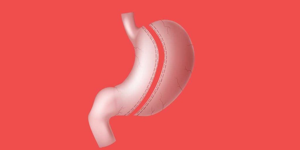 How to Avoid Gastric Sleeve Failure After Your Weight Loss Surgery Obesity Control Center