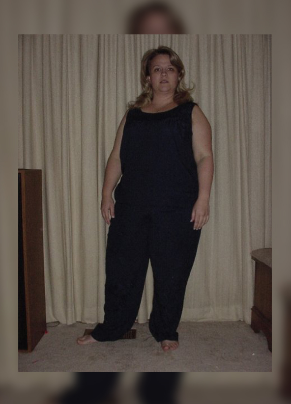 before photo for gastric lap band surgery in tijuana, mexico