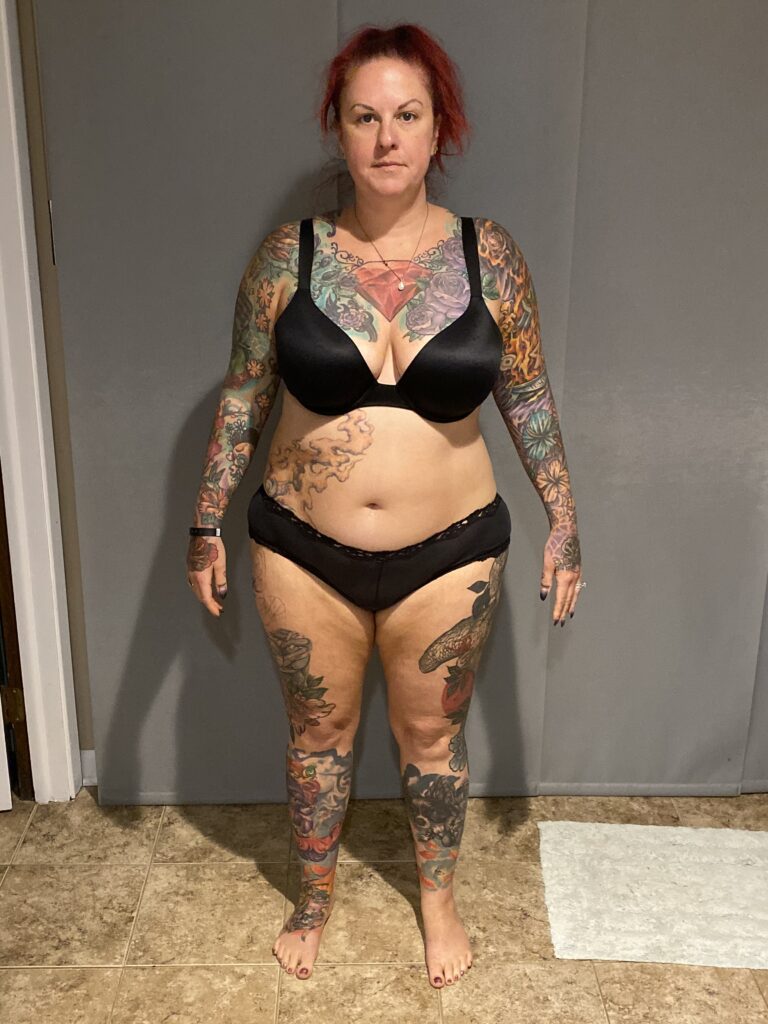 weight loss surgery before photo