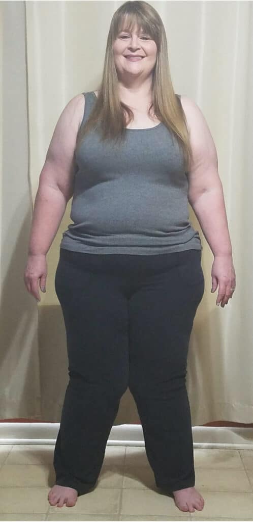 patient before her weight loss journey in Tijuana