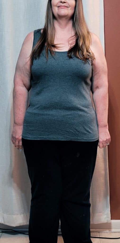 patient results after her weight loss surgery in Tijuana, Mexico