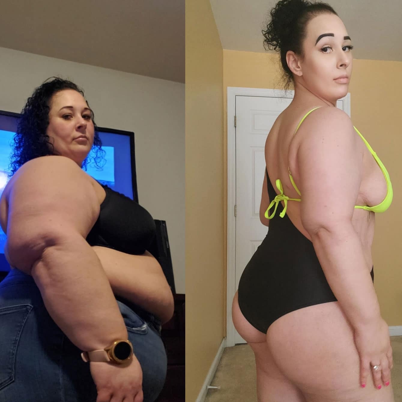 weight loss surgery before and after results in Tijuana