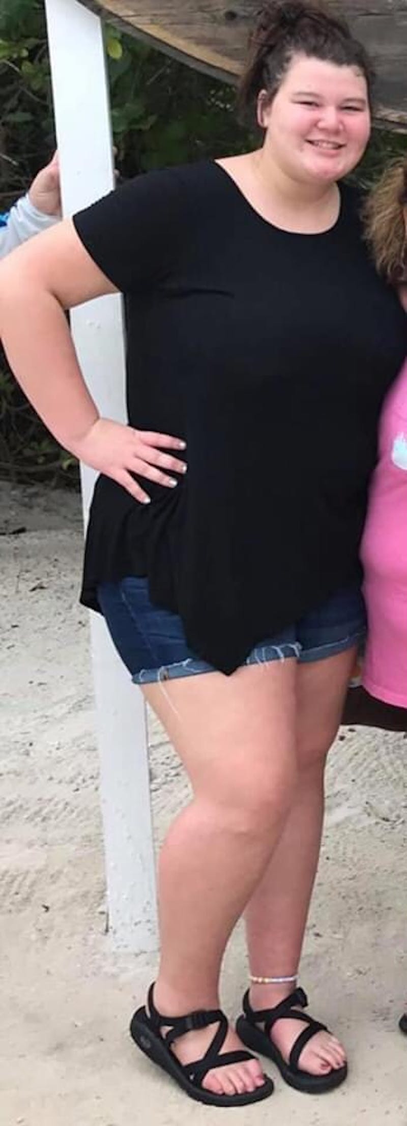 Patients 16-19 Years Old Before & After Gallery - Patient 14494144 - Image 1