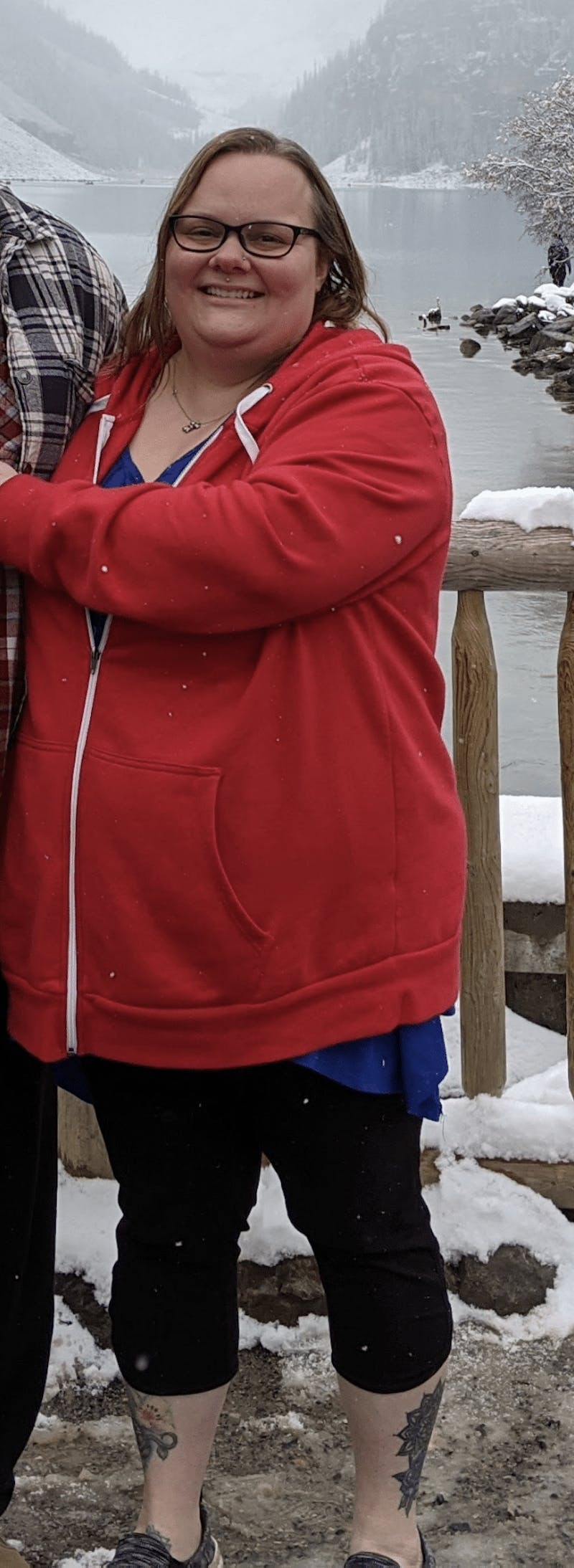 Patients 20-39 Years Old Before & After Gallery - Patient 14494153 - Image 1