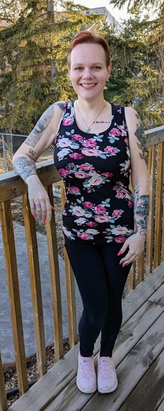 Patients 20-39 Years Old Before & After Gallery - Patient 14494153 - Image 2