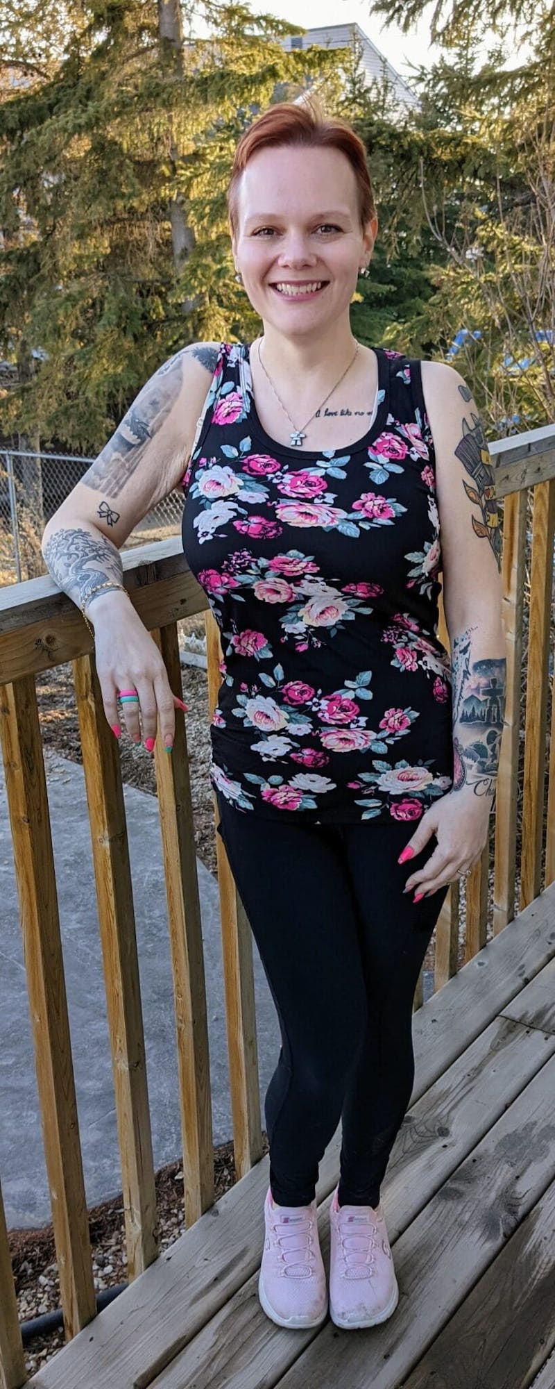 Patients 20-39 Years Old Before & After Gallery - Patient 14494153 - Image 2