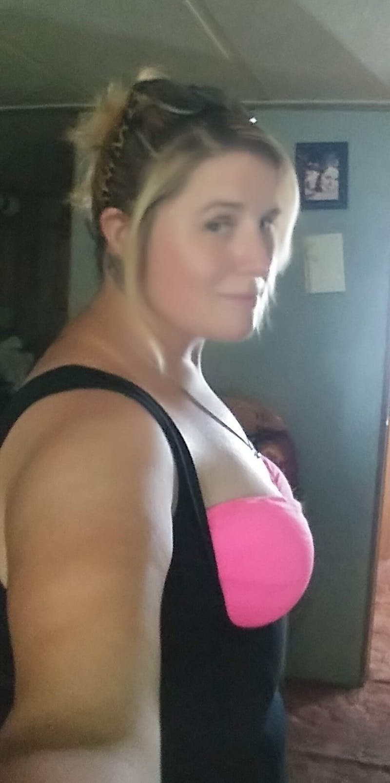 Patients 20-39 Years Old Before & After Gallery - Patient 14494155 - Image 1