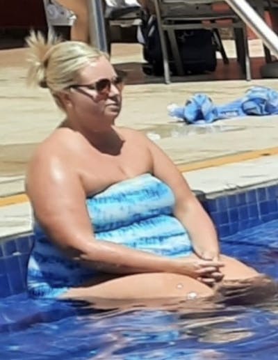 Patients 40-59 Years Old Before & After Gallery - Patient 14494158 - Image 1