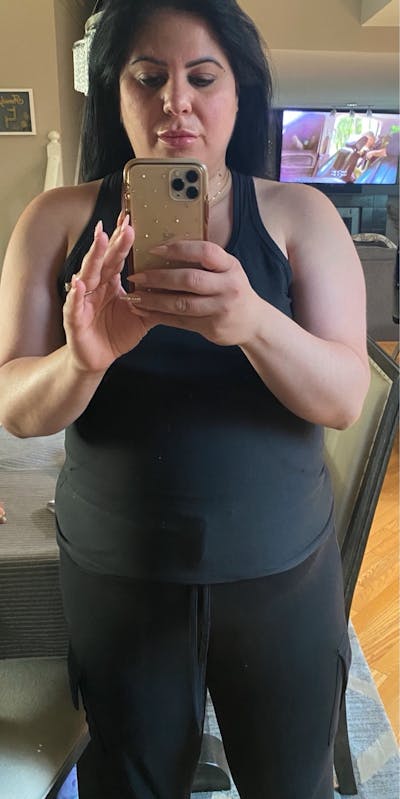 Patients 20-39 Years Old Before & After Gallery - Patient 14494171 - Image 1