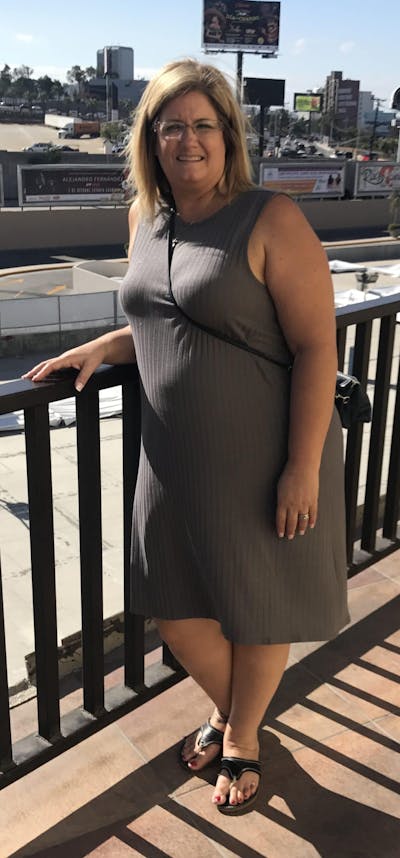 Patients 40-59 Years Old Before & After Gallery - Patient 14494176 - Image 1