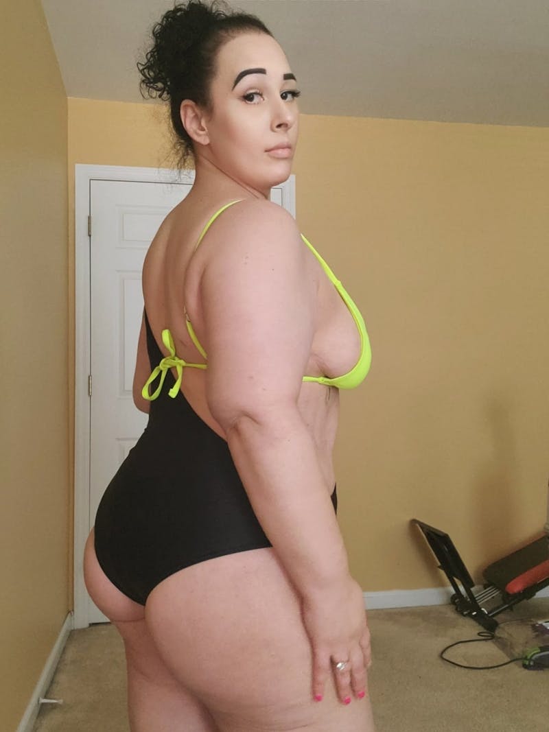 Patients 20-39 Years Old Before & After Gallery - Patient 14494177 - Image 2