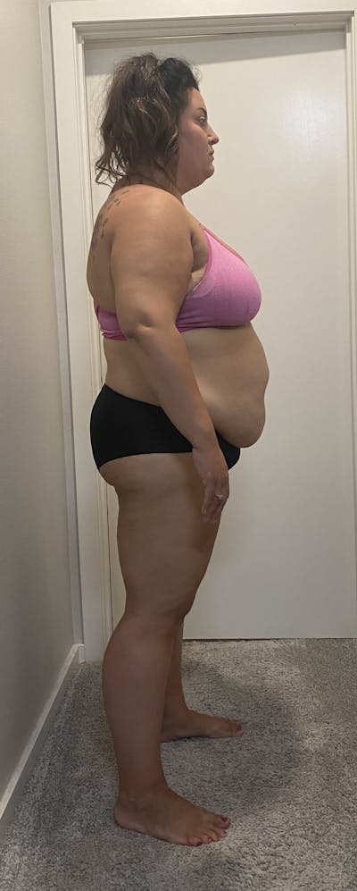 Patients 20-39 Years Old Before & After Gallery - Patient 14494180 - Image 1