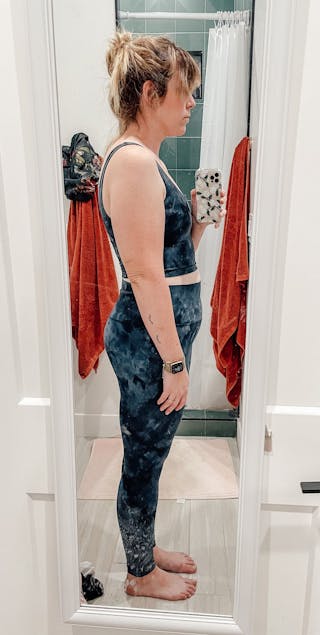 Patients 20-39 Years Old Before & After Gallery - Patient 14494186 - Image 2