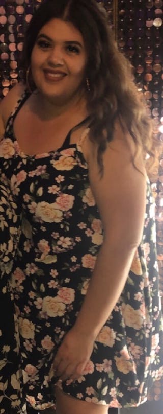 Patients 20-39 Years Old Before & After Gallery - Patient 14494190 - Image 2