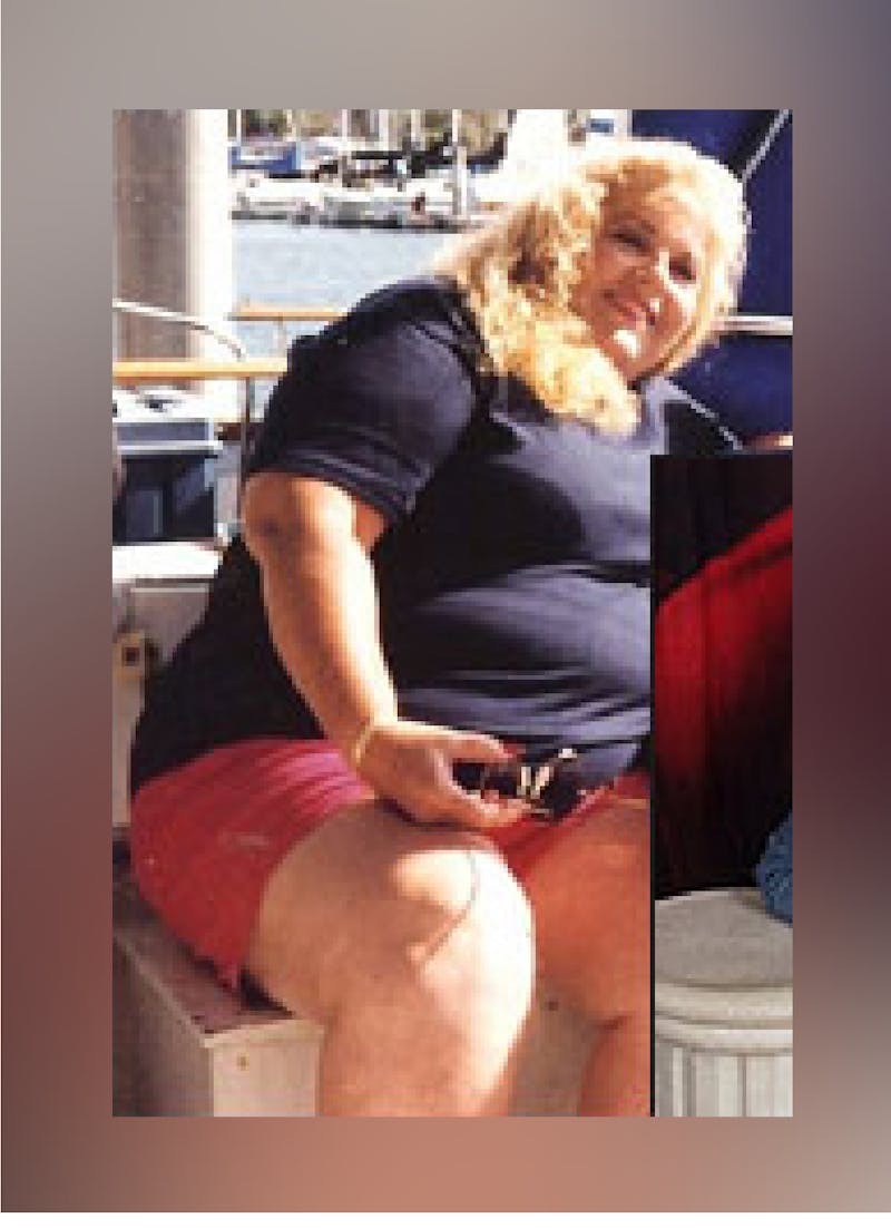 Patients 60-88 Years Old Before & After Gallery - Patient 14494196 - Image 1