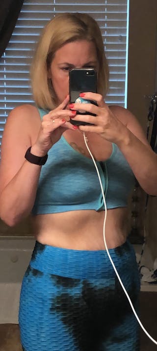 Patients 40-59 Years Old Before & After Gallery - Patient 14494199 - Image 2