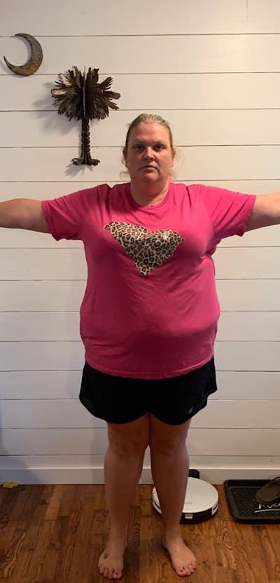 Patients 20-39 Years Old Before & After Gallery - Patient 14494200 - Image 1