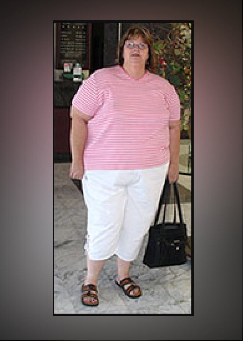 Patients 60-88 Years Old Before & After Gallery - Patient 14494201 - Image 1