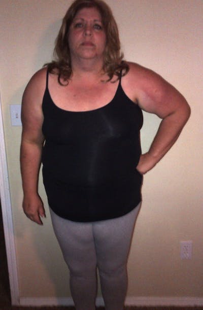 Patients 40-59 Years Old Before & After Gallery - Patient 14494202 - Image 1