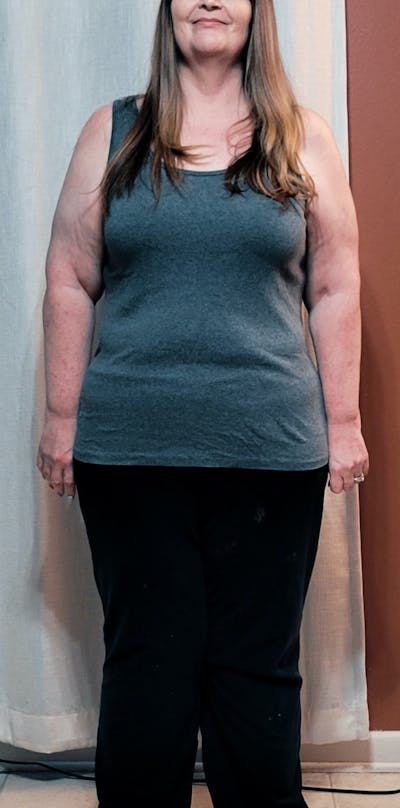 Patients 40-59 Years Old Before & After Gallery - Patient 14494208 - Image 2