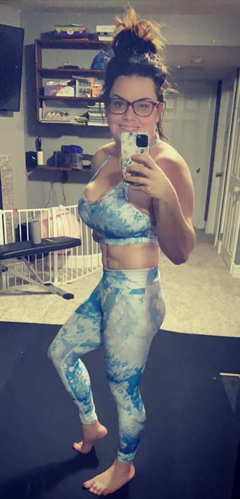 Patients 20-39 Years Old Before & After Gallery - Patient 14494207 - Image 2