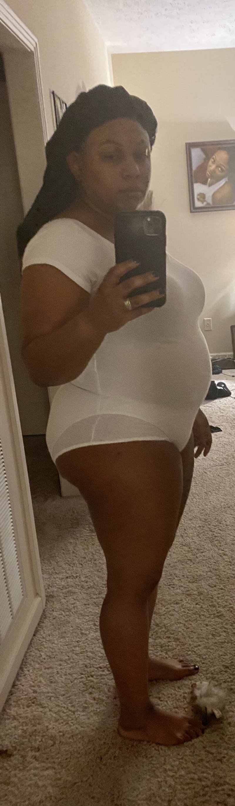 Patients 20-39 Years Old Before & After Gallery - Patient 14494209 - Image 1