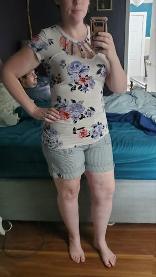 Patients 20-39 Years Old Before & After Gallery - Patient 14494246 - Image 2