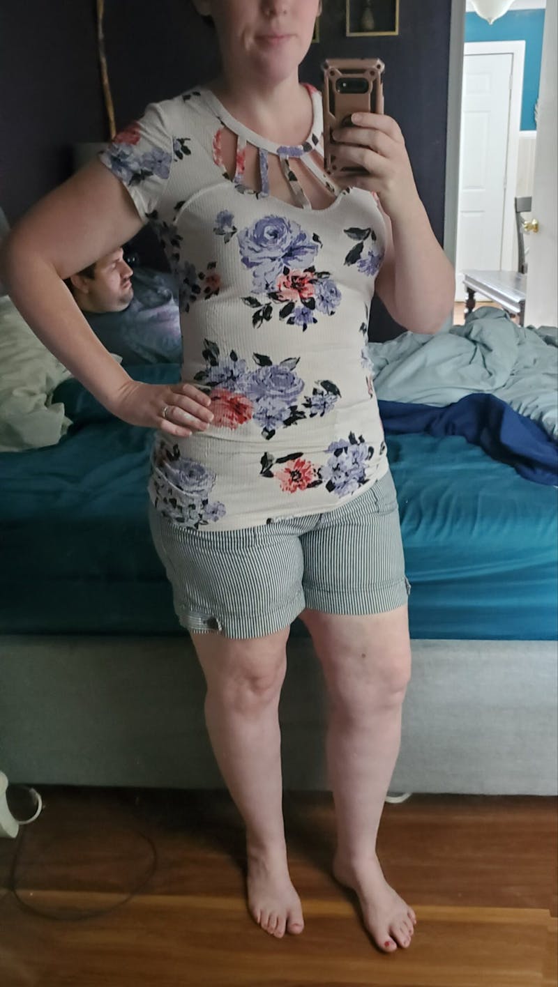 Patients 20-39 Years Old Before & After Gallery - Patient 14494246 - Image 2