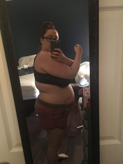 Patients 20-39 Years Old Before & After Gallery - Patient 14494261 - Image 1