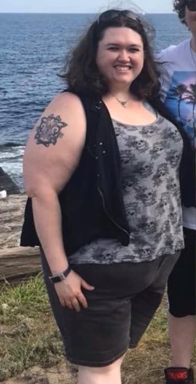 Patients 20-39 Years Old Before & After Gallery - Patient 14494262 - Image 1