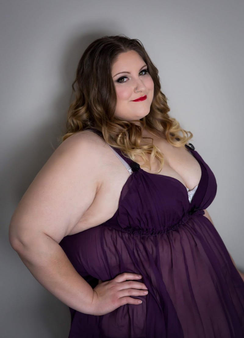 Patients 20-39 Years Old Before & After Gallery - Patient 14494265 - Image 1