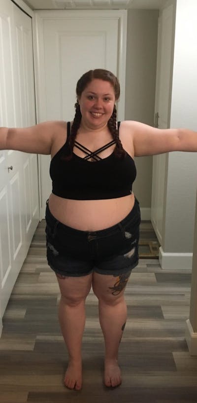 Patients 20-39 Years Old Before & After Gallery - Patient 14494267 - Image 1