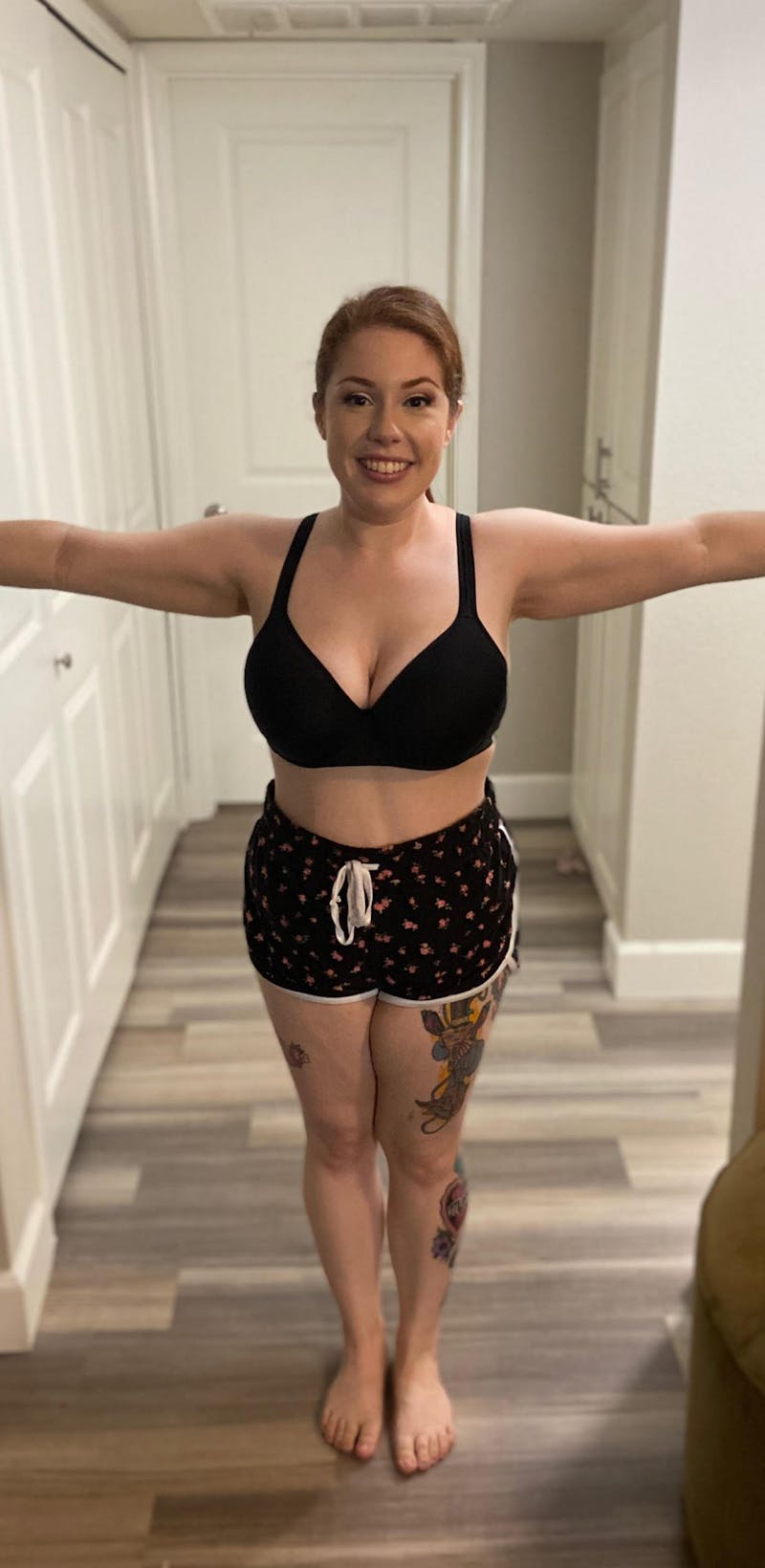 Patients 20-39 Years Old Before & After Gallery - Patient 14494267 - Image 2